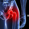 Total Hip Replacement in Chandigarh