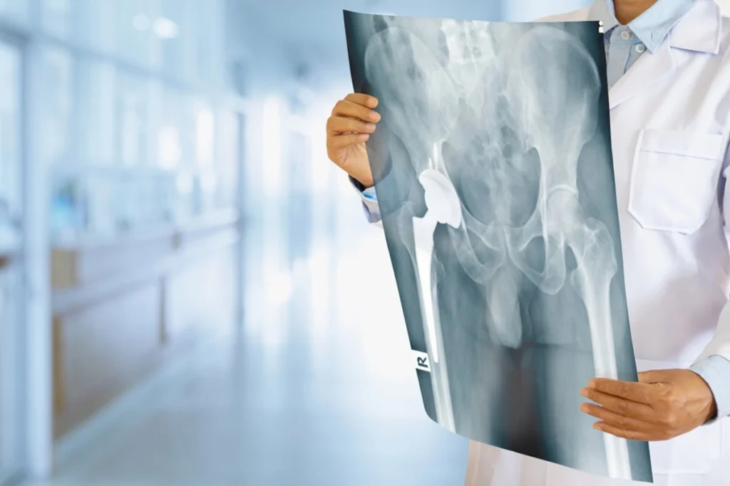 hip replacement surgery in Chandigarh