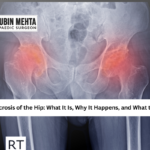 Avascular Necrosis Hip Treatment Chandigarh